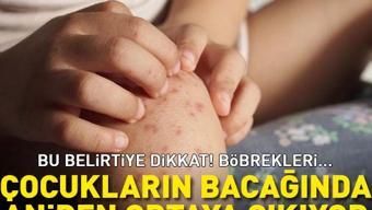 Böbrek taşının bu belirtilerine dikkat - görsel 4