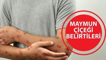 Çiçek hastalığı aşısı maymun hastalığına (Mpox) karşı koruma sağlar mı? - görsel 2